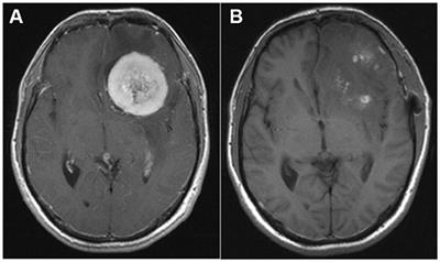 Cluster-Like Headache Secondary to Anamnesis of Sphenoid Ridge Meningioma: A Case Report and Literature Review